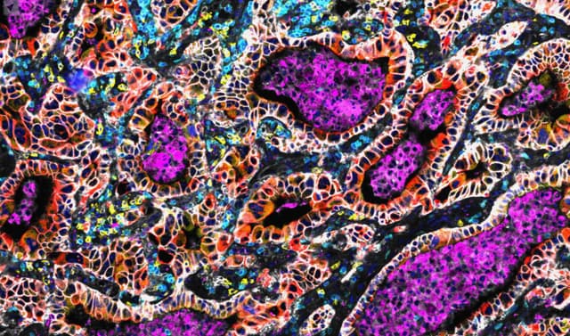 Will AI cure cancer?